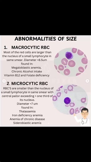 Rose Apple on Instagram: "🌸 Microcyte, Macrocyte and Normal RBC 🌸 👉 To report the red blood cell (RBC) ✨ Size, use the Nucleus of a small lymphocyte ✨ as a reference standard. 🌸 Microcyte🌸 An RBC that is clearly smaller than the nucleus of a small lymphocyte. 🌸 Macrocyte 🌸 An RBC that is larger than the nucleus of a small lymphocyte. 🌸 Normal 🌸 An RBC that is equal in size or approximately the same size as the nucleus of a small lymphocyte. Share Knowledge and Answer questions for Hemat
