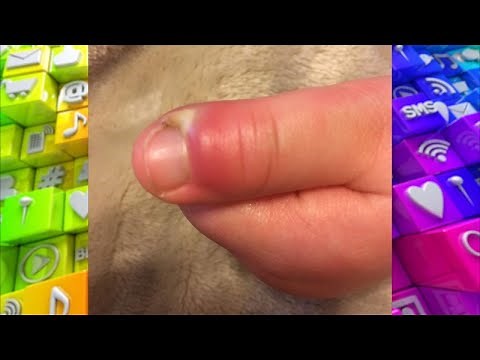 How to Treat an Infected Hangnail + Future Prevention