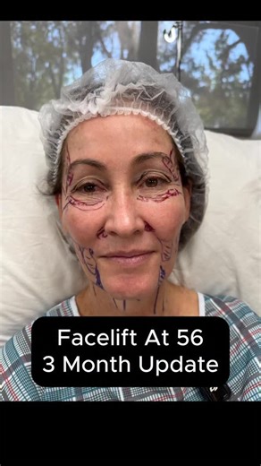 ✨ Heather’s Deep Plane Facelift Journey - 3 Months Post-Op 👀 Three months out from her deep plane facelift, Heather is finally reaching the point where everything is settling, but what makes her story so important is how honest she’s been about the emotional reality of recovery. It’s easy to compare yourself to others who healed quickly, but that’s not for everyone. In Heather’s case, she’s had multiple non-surgical treatments - thread lifts, Ultherapy, Morpheus8 treatments, FaceTite and MyElle