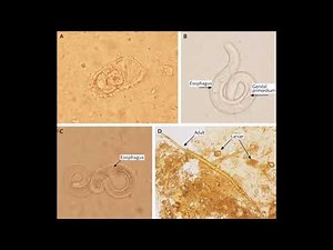 Strongyloides stercoralis - morphology, life cycle, pathogenesis, diagnosis and treatment
