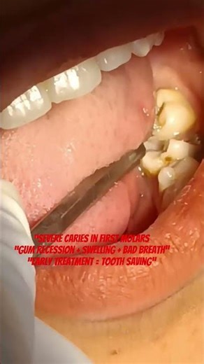 Severe Tooth Decay Case FillingvsRCTvsExtraction Complete DentalTreatment Explained#thedentalguru
