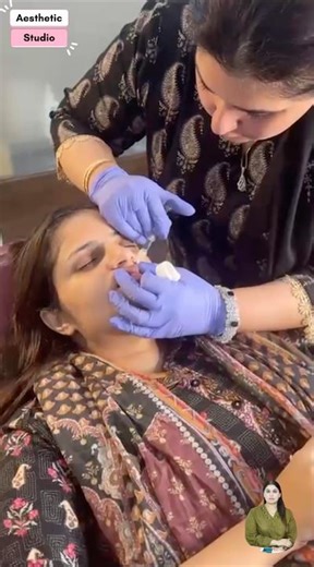 Lip Flip with Botox | Botox & Fillers | Lip Filler | Process, Journey, Result, Before and After