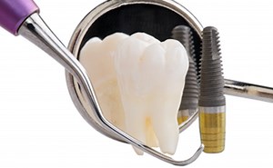 Dental Implants Cost Melbourne | Cheap Dental Implants