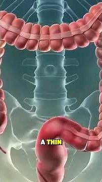 How a Polypectomy Procedure Is Performed | Step-by-Step Surgical Explanation #polypremoval