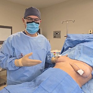 Mastopexia… Levantamiento de senos sin implantes En este caso hay una caída prominente del seno, en ambos lados estaban iguales. Aquí ya el lado derecho está operado (acabamos de trabajar). Quiero hacer la comparativa donde hay una caída donde la punta está completamente hacia abajo. Lo que observan es la diferencia donde sin usar implantes se puede lograr una mastopexia con una forma que simula como si tuviese implante la paciente. No siempre es necesario el implante, específicamente si la paci