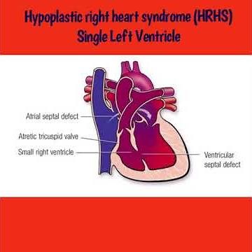 Hypoplastic Right Heart Syndrome (HRHS) Single Left Ventricle
