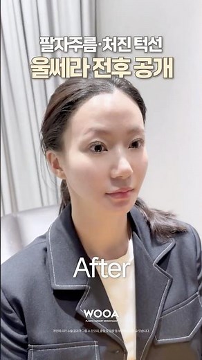 Smile Lines & Sagging Jawline, Ultherapy Before & After Reveal | Before & After
