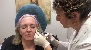 Botox treatment for crows feet