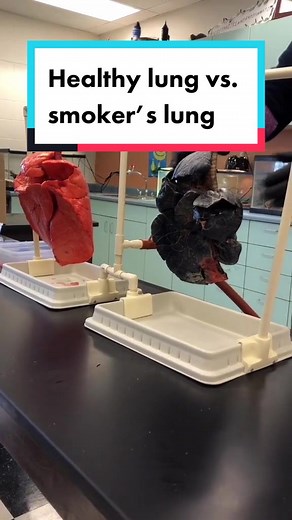 Normal lung vs. smoker’s lung. #lungs #healthyliving #health #science Source: @Zarahi OZ