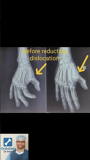 MCP joint dislocation ! finger dislocation! reduction of dislocation #fracture #dislocated
