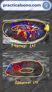 Normal vs Abnormal Lymph Node Ultrasound #ultrasonography #ultrasoundtraining