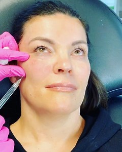 Do you need cheeks? Yes! We all need cheeks! Did you know that 70% of your facial beauty comes from your mid-cheek position. That’s correct! The cheeks position prevents jowling and heaviness! This beauty came in for a little cheek contouring with calcium based filler, #Radiesse! Some of the most recognized actresses and models are known for their beautiful, contoured cheeks and I love the way this procedure enhances facial features without any downtime. 💕 After discussing this patients treatme