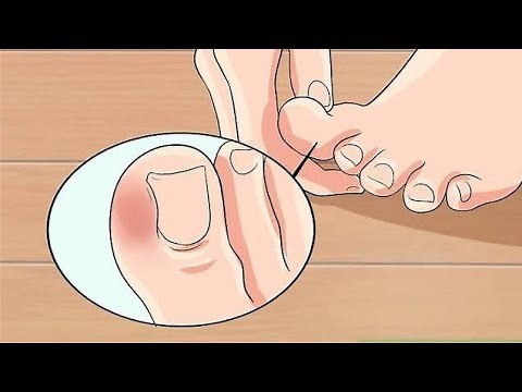 How to Cure an Infected Toe