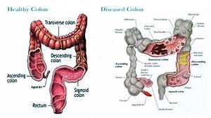 Colon Cleanse Recipe - CLEANSE YOUR COLON AND LOSE 20 POUNDS IN 3 WEEKS