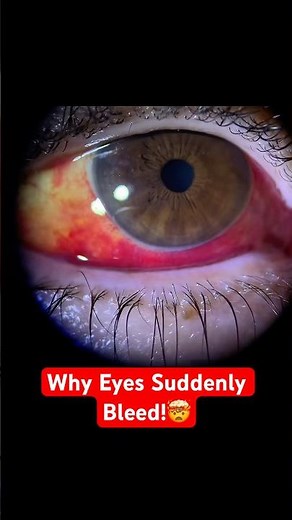 Why Your Eye Randomly Turns Red
