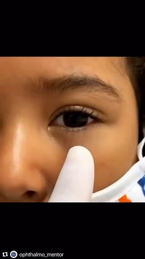 Dr. Stefano Russo on Instagram: "Conjunctival cyst Conjunctivital Cist is a sac-like lesion with a thin wall that contains clear or sometimes turbid fluid. This lesion can be congenital or acquired. Congenital cysts can remain hidden in the fornix and gradually increase with age. Acquired cysts can appear after eye trauma, after surgeries such as strabismus, pterygium, scleral buckling, resulting from conjunctivitis such as trachoma, rarely after medication, or even spontaneously. Most patients 