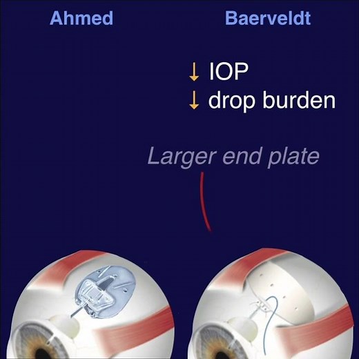 AVB - Ahmed vs Baerveldt Study