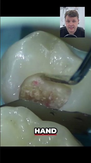 Pulp Exposure Dental Diagnosis & Treatment Guide!