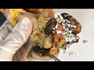 CUT Ingrown Toenails 👣 Toenails with Maggots, Fungal Toenails // Toenails N1010