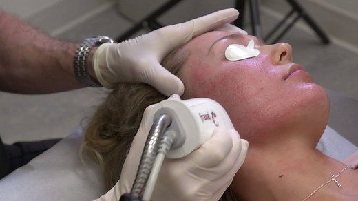 Watch Dr. Kelleher conduct an actual Fraxel laser procedure to reduce a scar and reverse visible signs of aging. | Premier Dermatology