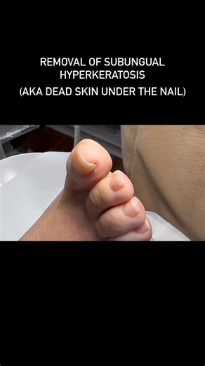 ✨ Satisfying & pain-free relief ✨ This video shows the gentle reduction of subungual hyperkeratosis (hardened dead skin that can build up under the corner of the nail). Why this matters 👇 • Can cause pressure and pain • Often mistaken for an ingrown nail • Relief is often instant when reduced correctly ✔️ Carried out slowly and carefully ✔️ Pain-free for the patient ✔️ Immediate comfort restored If you’re dealing with nail edge discomfort or pressure under the nail, help is available 💙 📍 Happ