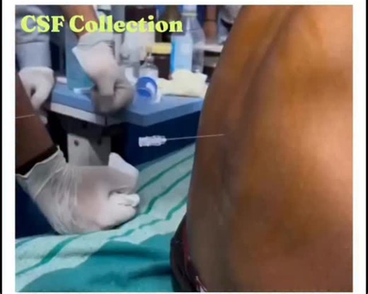 RK NURSE'S HUB on Instagram: "Cerebrospinal fluid (CSF) collection is a medical procedure used to obtain a sample of the clear, colorless fluid that cushions the brain and spinal cord. In 2026, it remains a critical diagnostic tool for identifying central nervous system (CNS) infections, autoimmune disorders, and intracranial hemorrhages. Common Collection Methods Lumbar Puncture (Spinal Tap): The most frequent method, where a sterile needle is inserted into the lower back between lumbar vertebr