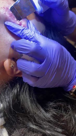 Today’s pimples 🤍😍 #pimplepop #pimplepopperaddict #cleanskin | pimples videos