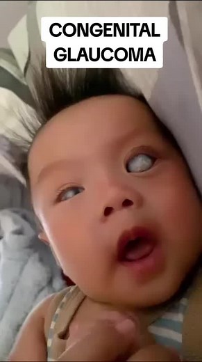 Understanding Congenital Glaucoma in Babies | Eye Diseases Explained