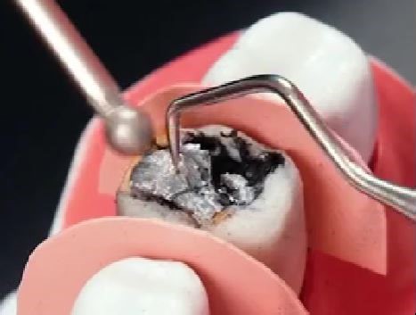 2.6M views · 5.8K reactions | How do dental procedures actually work | 5-Minute Crafts | Facebook