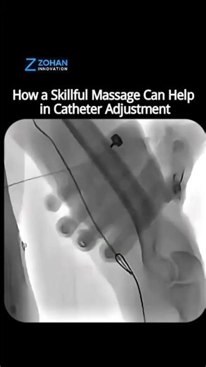 Mastering Catheter Adjustment with Gentle Massage Techniques 💆‍♂️🩺