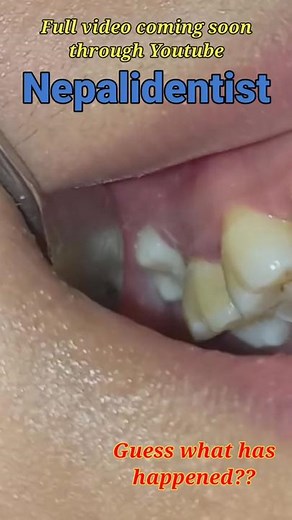 Abnormally erupted wisdom tooth should be extracted #wisdom #tooth #drbiplob #premierdentalnepal #दन्त #स्वास्थ्य #प्रिमियरडेन्टल #awareness