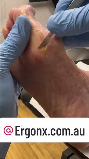 Satisfying Foot Callus Removal by Podiatrist #Podiatry #FootCare