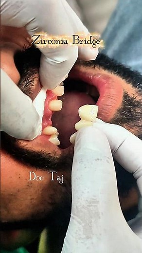 Zirconia Bridge and Crown Treatment || High quality zirconia || Best fixed teeth treatment #smile