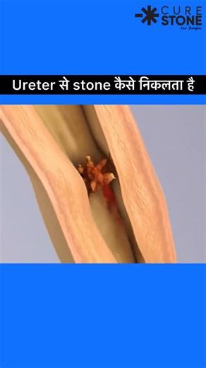 🚨 When a kidney stone enters the ureter, it’s not just a stone—it’s a moving blade! ⚡ Watch how it travels, scraping and injuring the delicate inner lining of the ureter. This explains why patients feel unbearable colicky pain radiating from the back to the groin. 💥 👉 Don’t ignore the pain. Early diagnosis and treatment can save your kidney. Hashtags: #KidneyStone #UreterStone #UrologyAwareness #StonePain #CureStone #Ureter #KidneyHealth #LaserTreatment #RIRS #StoneTreatment #KidneyCare #Urol