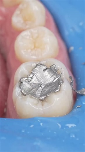 🦷 Amalgam Restoration | Step-by-Step Procedure
