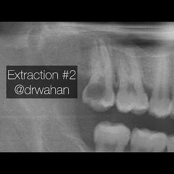Simple Extraction of a Molar