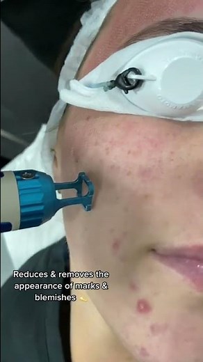 iPixel Laser for acne scarring & big pores | Dr. Medispa