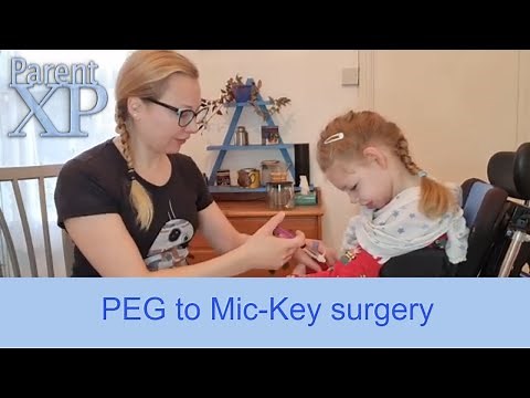 Peg To Mic-Key surgery needed