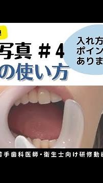 Intraoral photo #4 "How to use the lip hook"