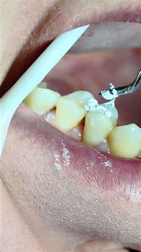 The satisfying moment a temporary filling becomes permanent #dentist #asmr