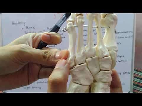 5th Metatarsal Base fractures: Jones fracture??