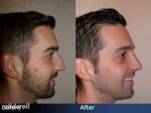 Nose Job Before & After - Male Rhinoplasty in NYC