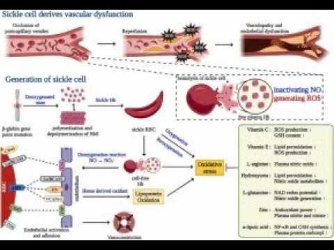 Pathophysiology Sickle Cell Anemia; Genetic Mutation, Hemoglobin Polymerization