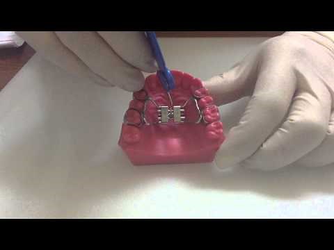 Rapid Maxillary Expansion Instructions
