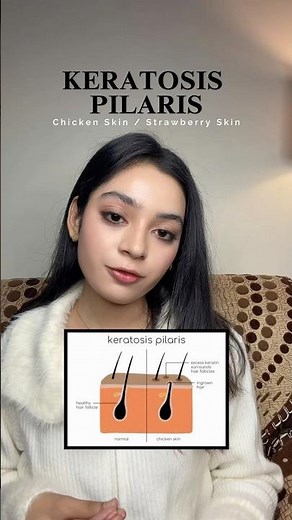 How to Treat Keratosis Pilaris on Arms and Legs Simple Routine #Keratosispilaris #Skincareroutine