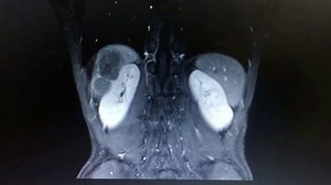 Laparoscopic Anterior Right Hepatectomy: A Single-Center Experience