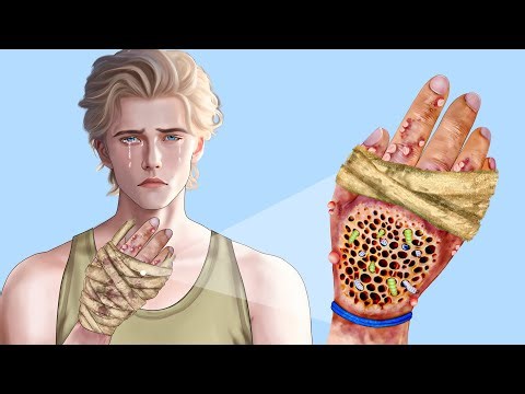 ASMR Worm & Maggot Hand Infected | Deep Cleaning Animation