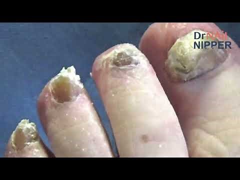 Toenails Not Cut in 3 Years. FEET-ure Friday (2023)