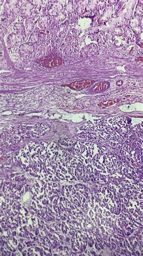 Pancreatic heterotopia in stomach !