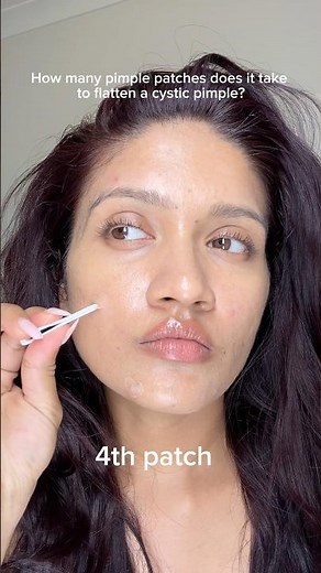 This cystic pimple took 6 pimple patches to finally flatten.